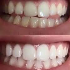 Snowhite Teeth Whitening – Amazon – comment utiliser – forum
